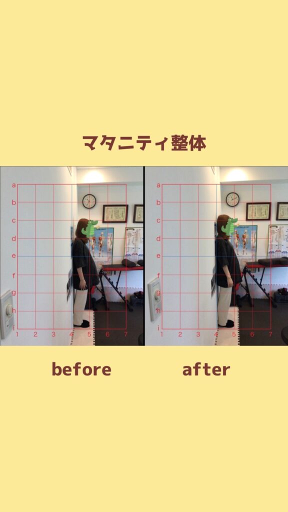 マタニティ整体でのビフォーアフターの写真