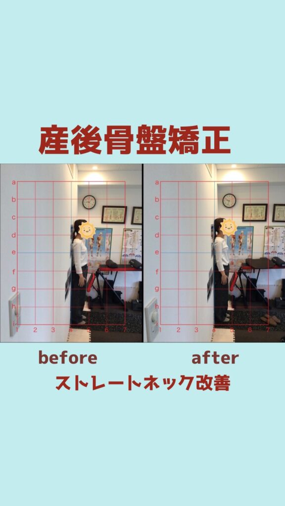 産後骨盤矯正でのビフォーアフターの写真
