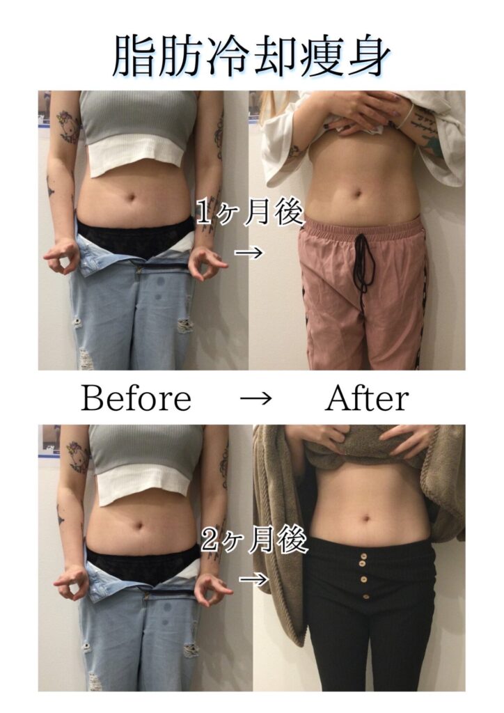 脂肪冷却before＆after