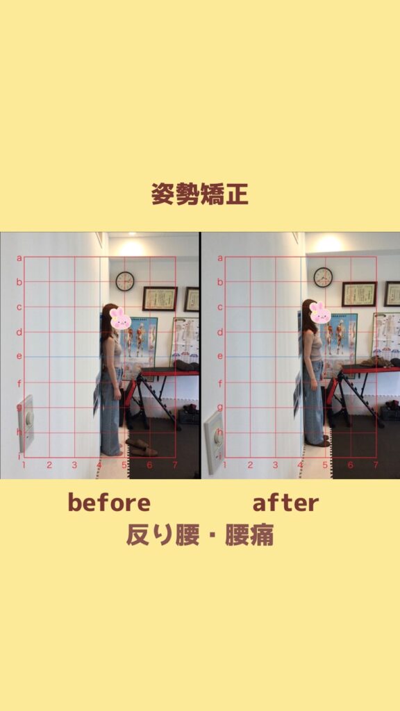 姿勢矯正before＆after