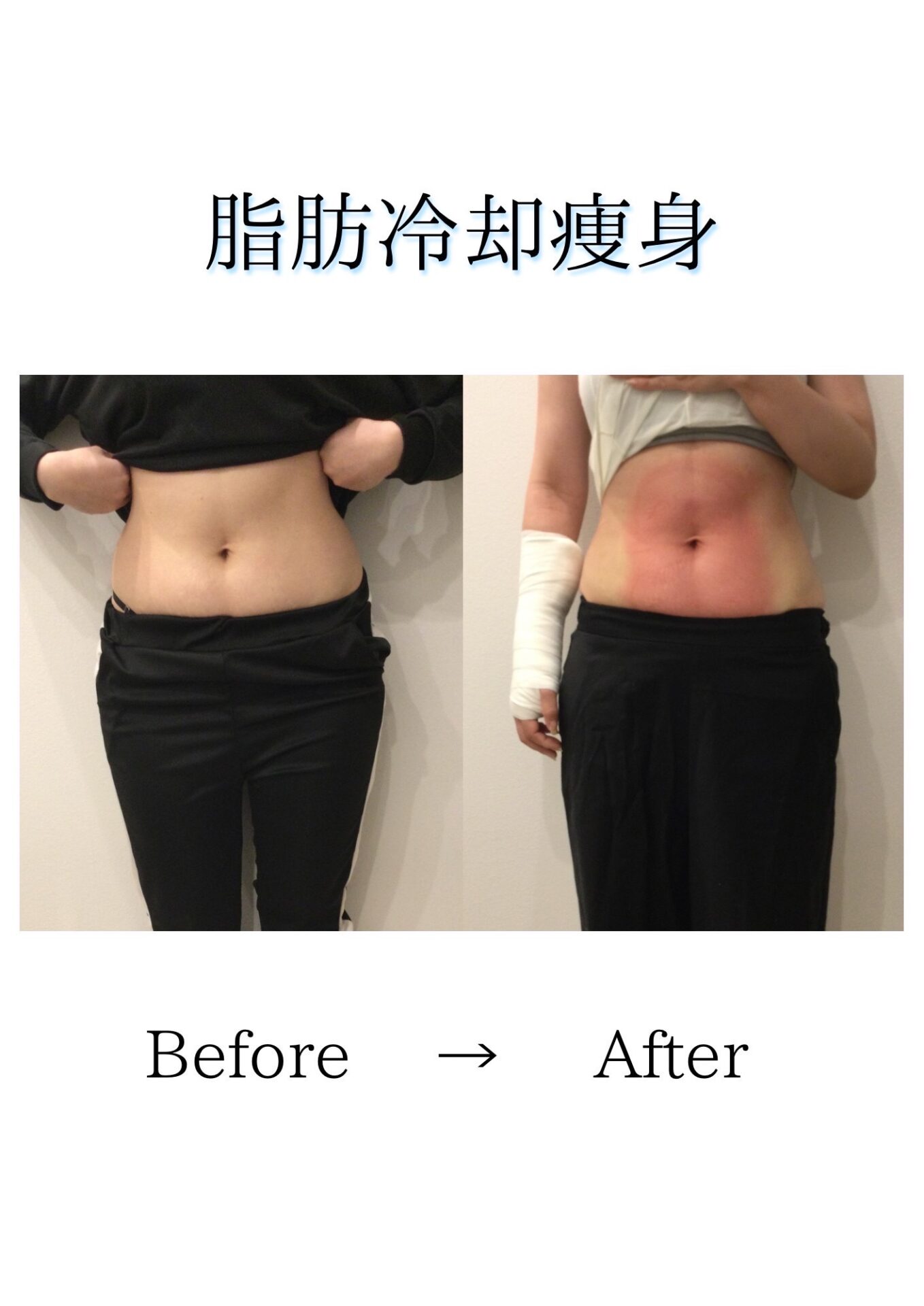 脂肪冷却 【公式通販】