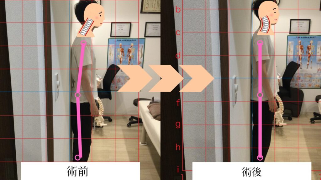 ストレートネックの整体後の写真