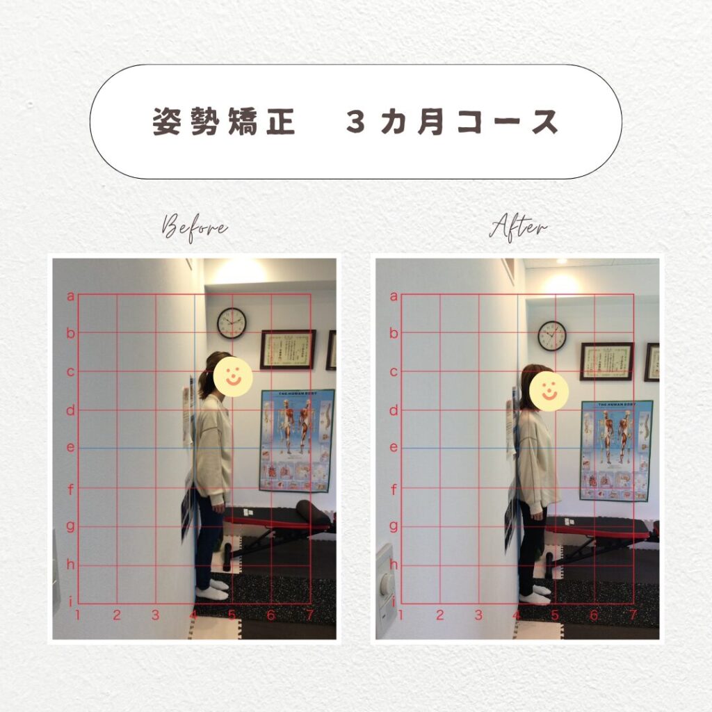 姿勢矯正before＆after