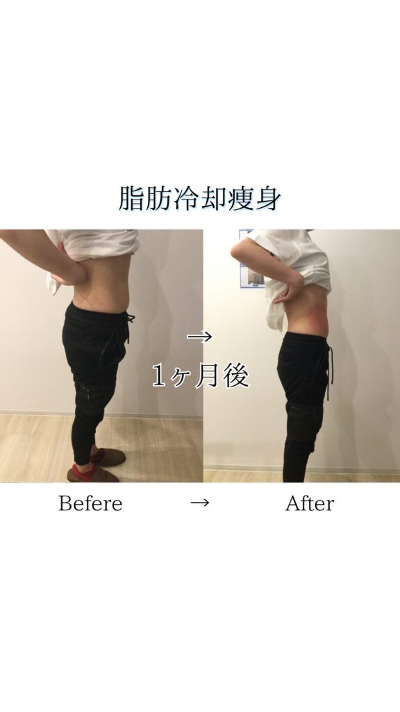 脂肪冷却before&after