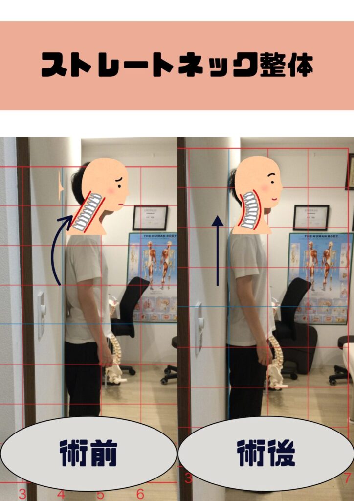 ストレートネックbefore＆after