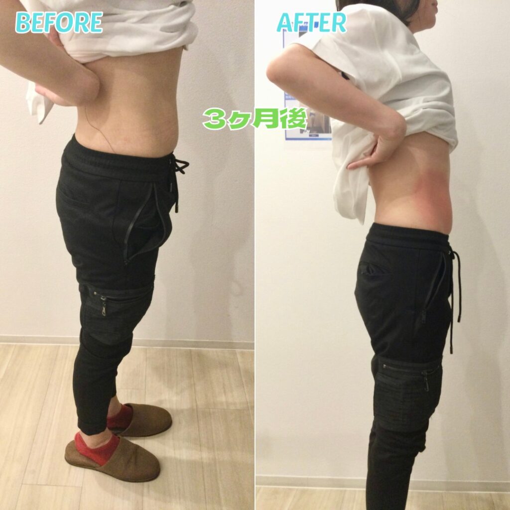 脂肪冷却before&after