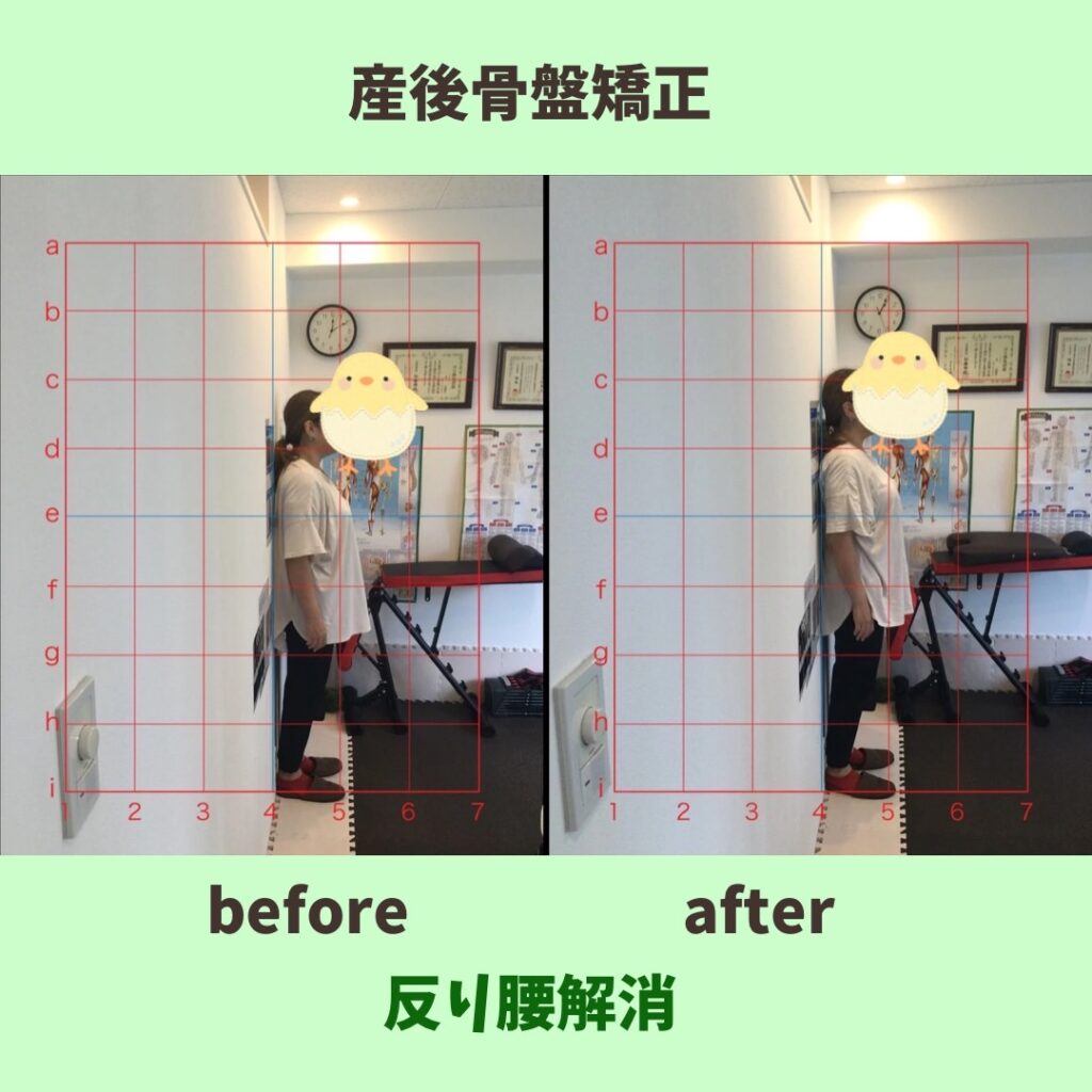 産後骨盤矯正before&after