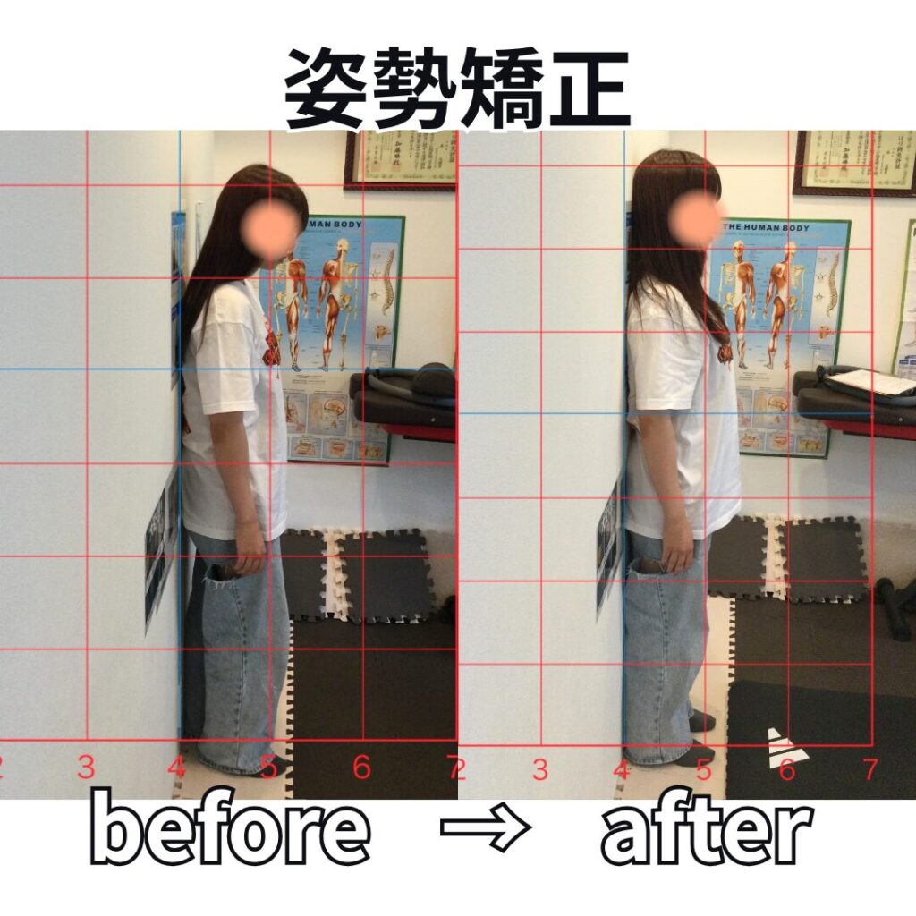 姿勢矯正ビフォーアフター