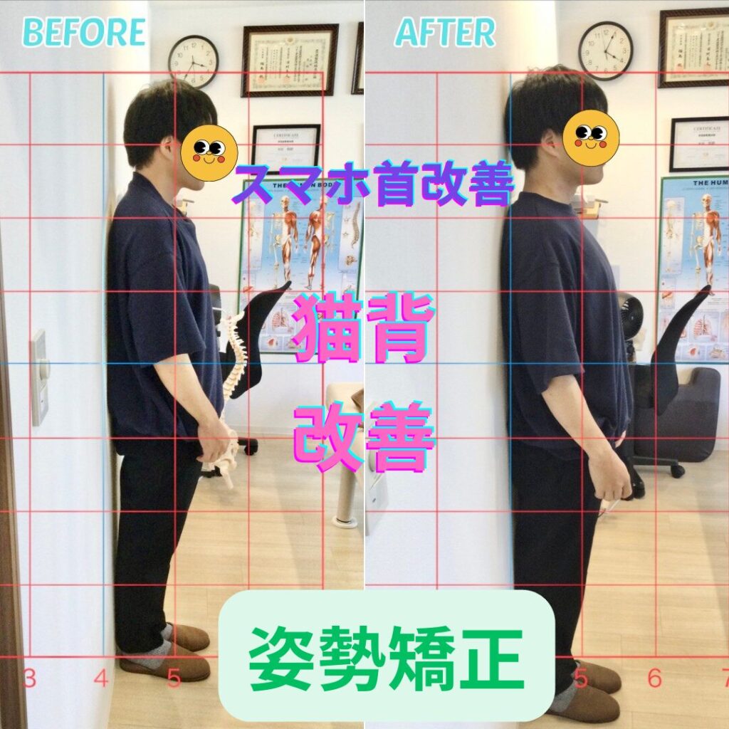 姿勢矯正ビフォーアフター
猫背・スマホ首