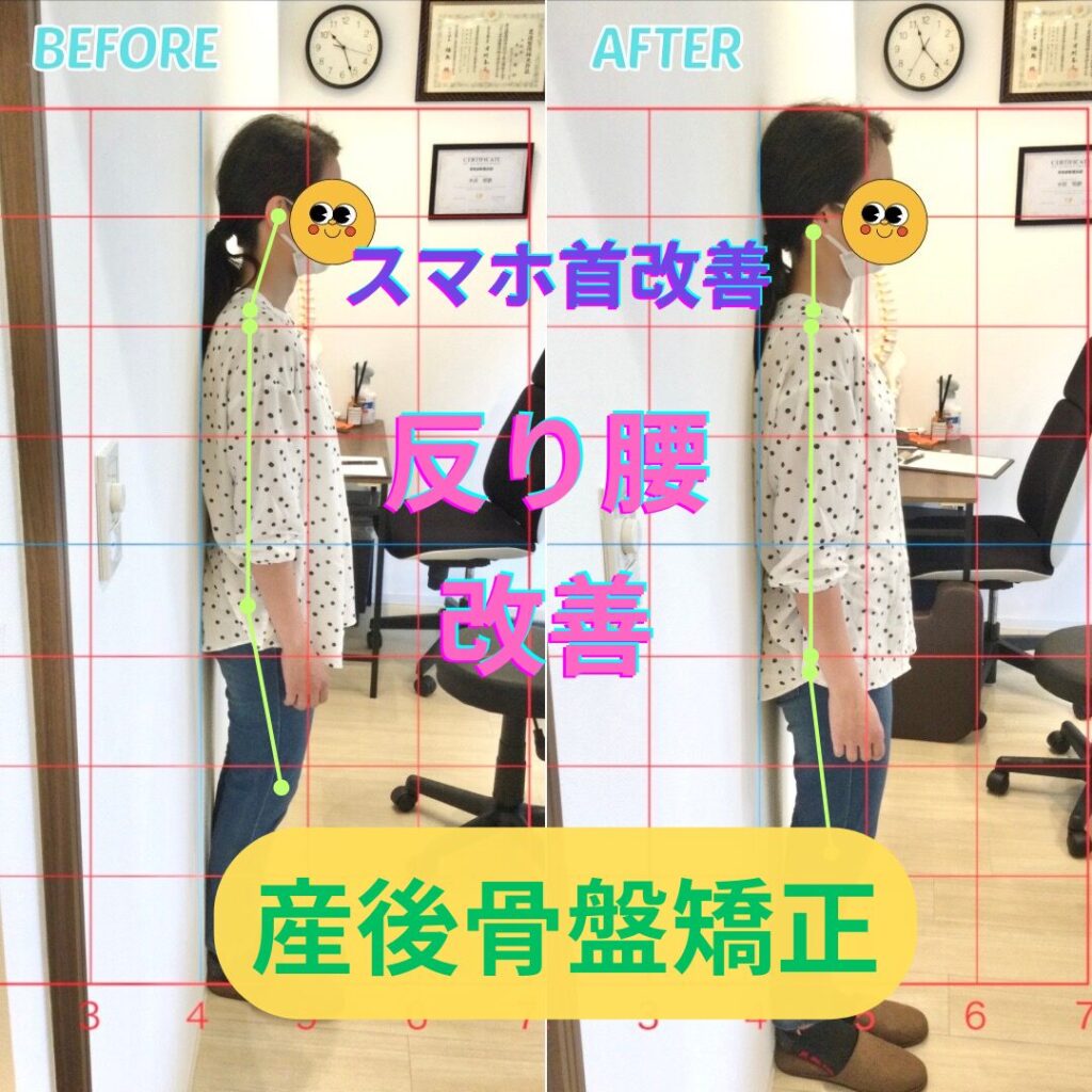 スマホ首ビフォーアフター