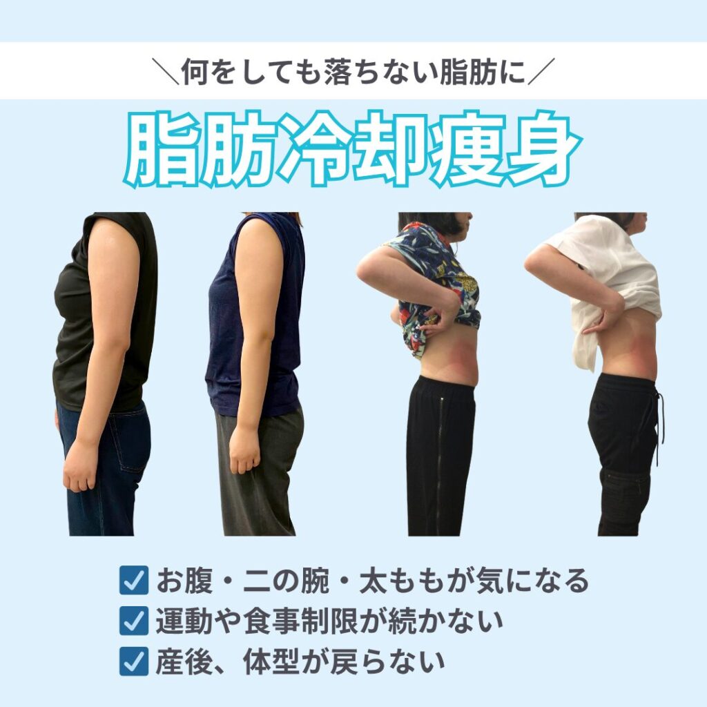何をしても落ちない脂肪に脂肪冷却瘦身