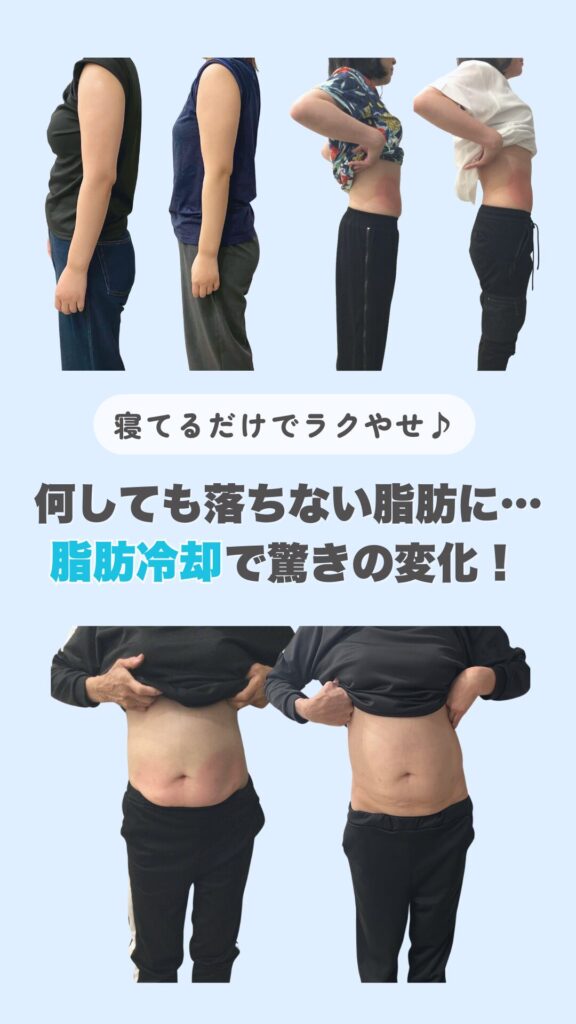 何をしても落ちない脂肪に…
脂肪冷却ビフォーアフター