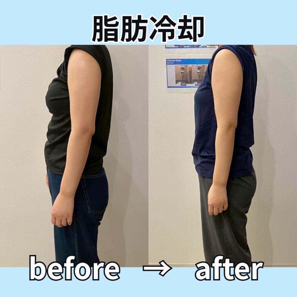 脂肪冷却二の腕ビフォーアフター