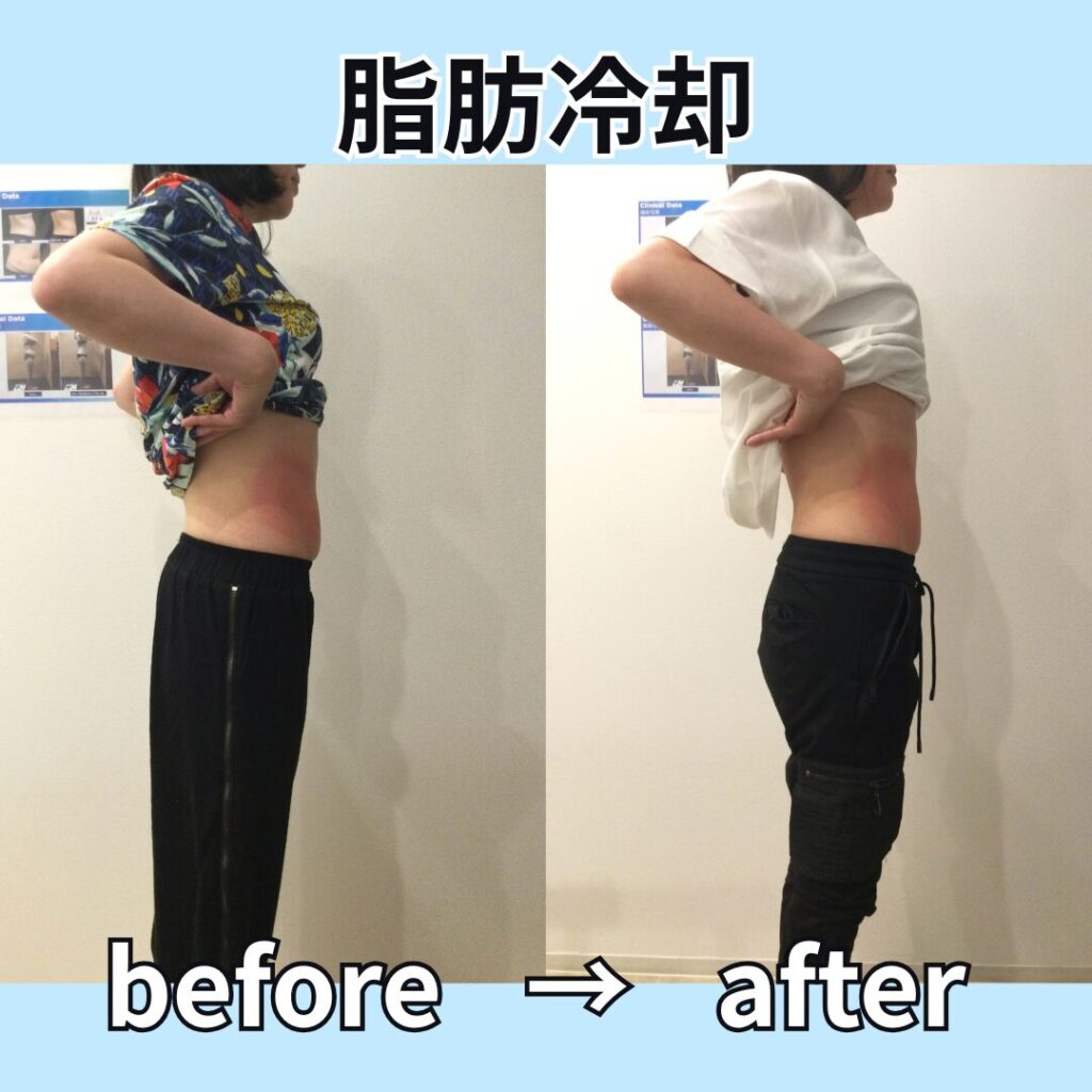 脂肪冷却ビフォーアフター