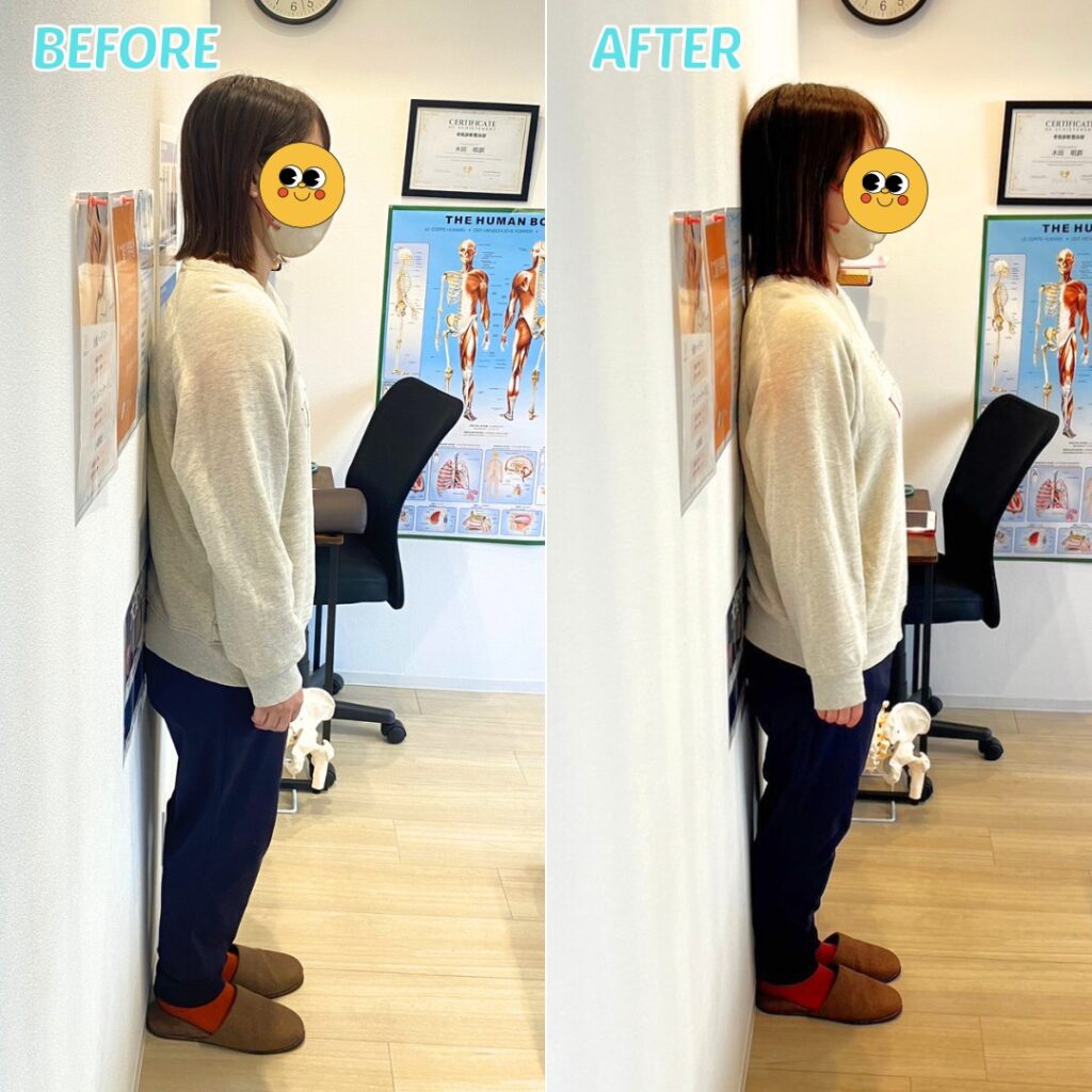 姿勢矯正ビフォーアフター