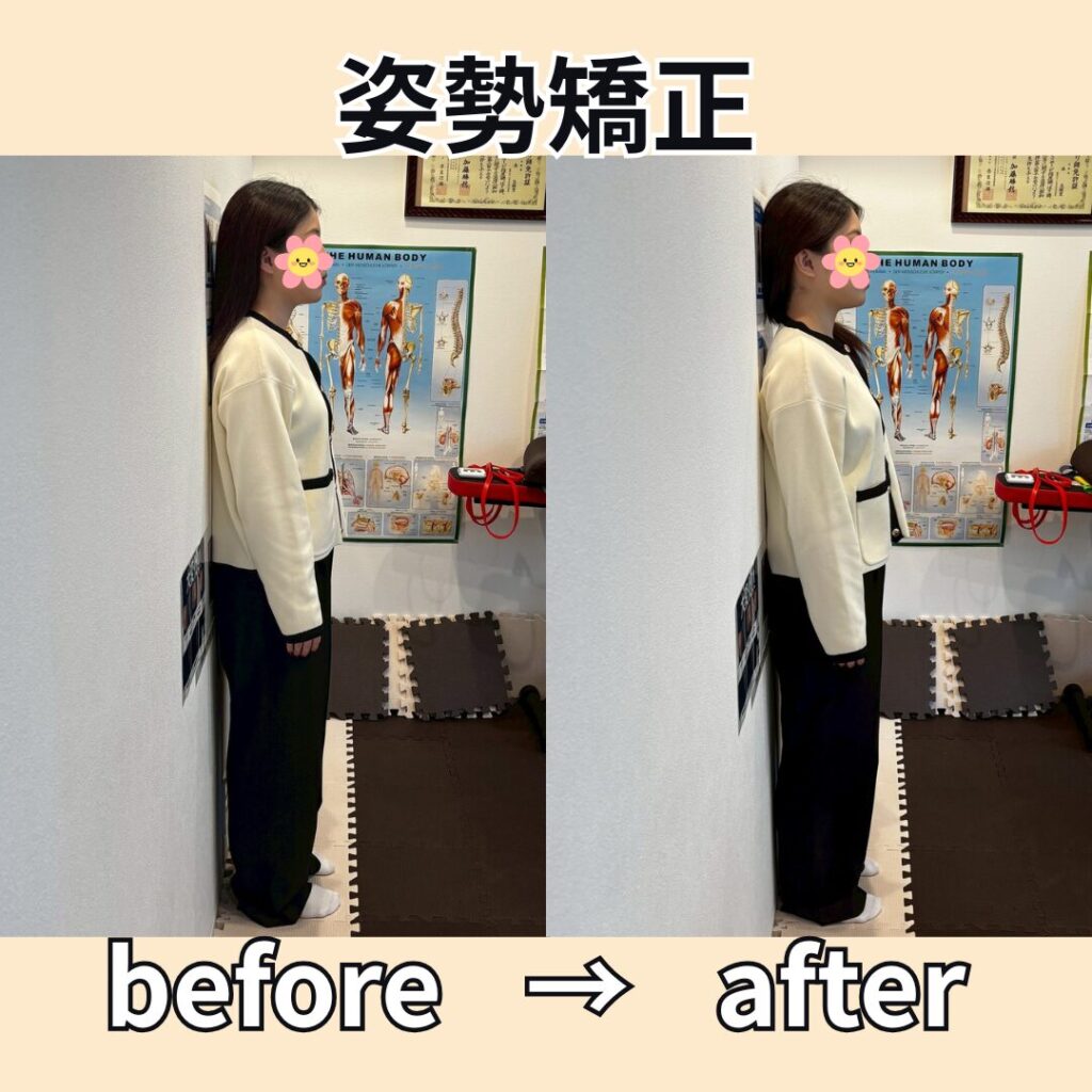 姿勢矯正before＆after