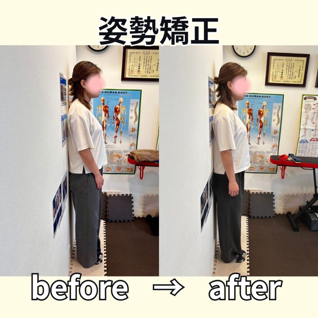 姿勢矯正ビフォーアフター