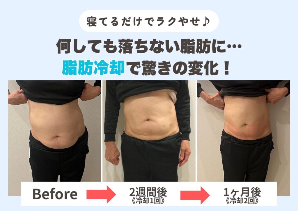 脂肪冷却瘦身ビフォーアフター
