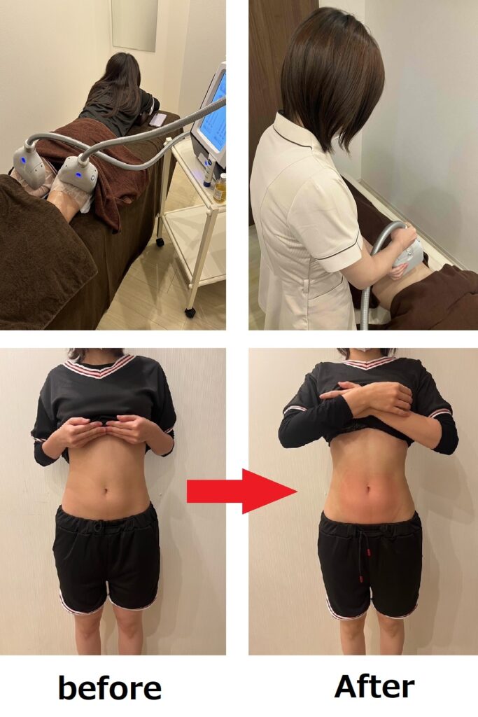 脂肪冷却痩身ビフォーアフター