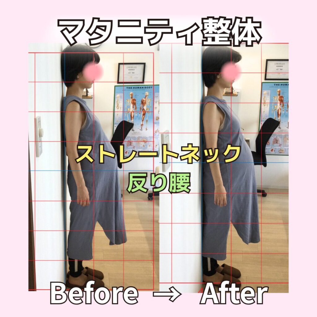マタニティ整体ビフォーアフター