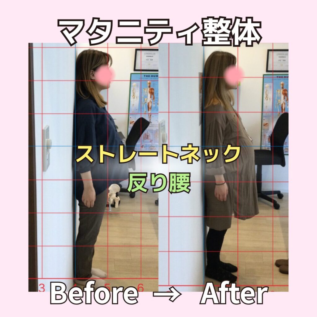 マタニティ整体ビフォーアフター