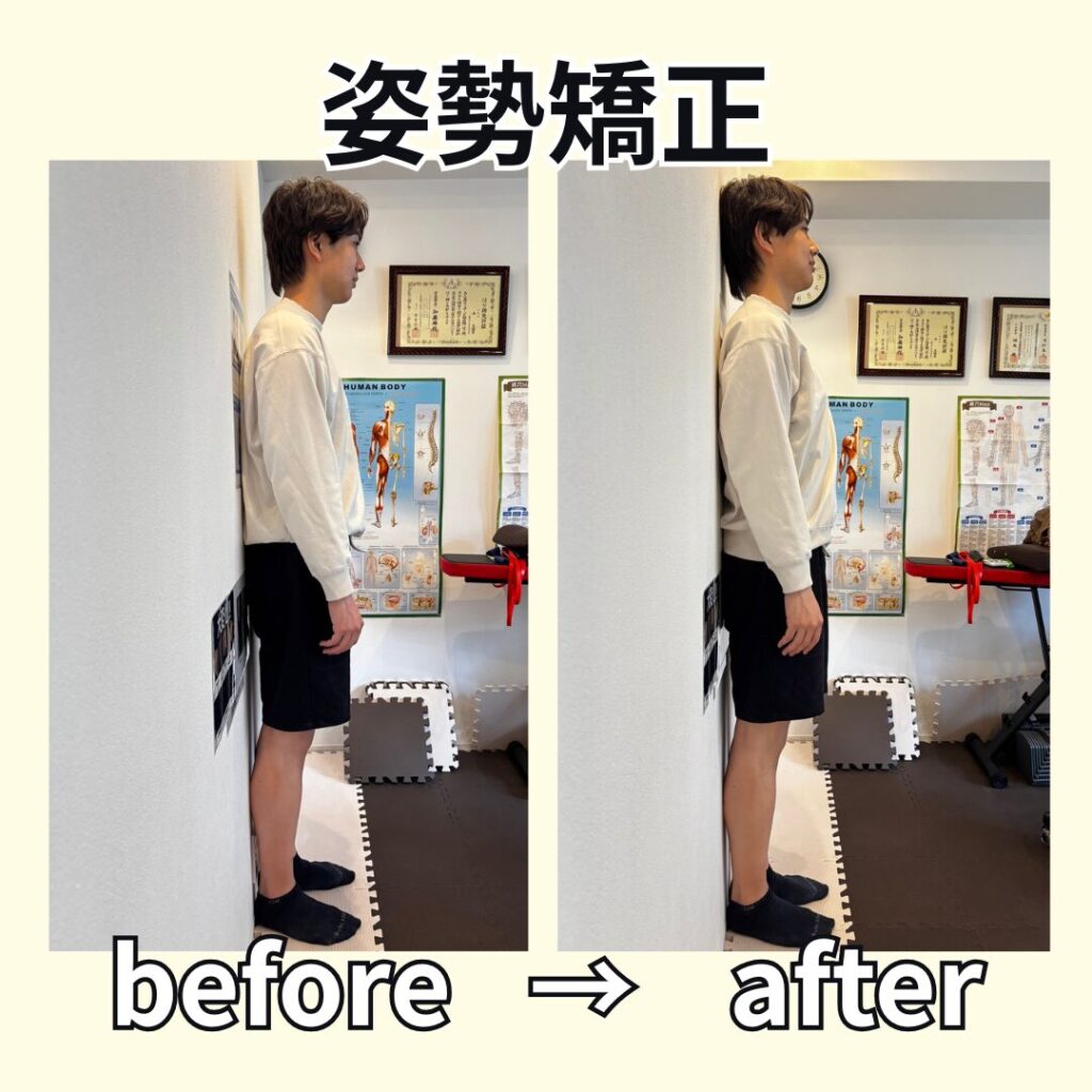 姿勢矯正ビフォーアフター