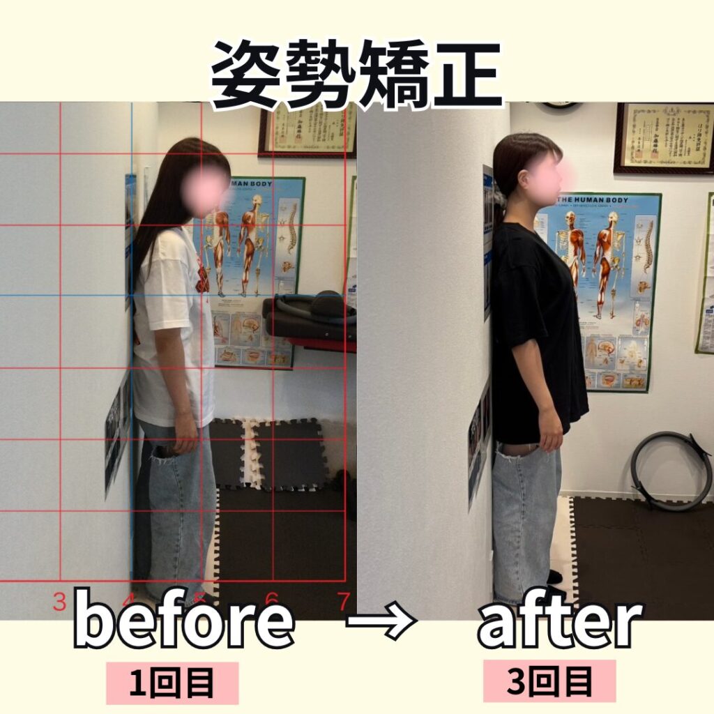 姿勢矯正ビフォーアフター
1回目→3回目