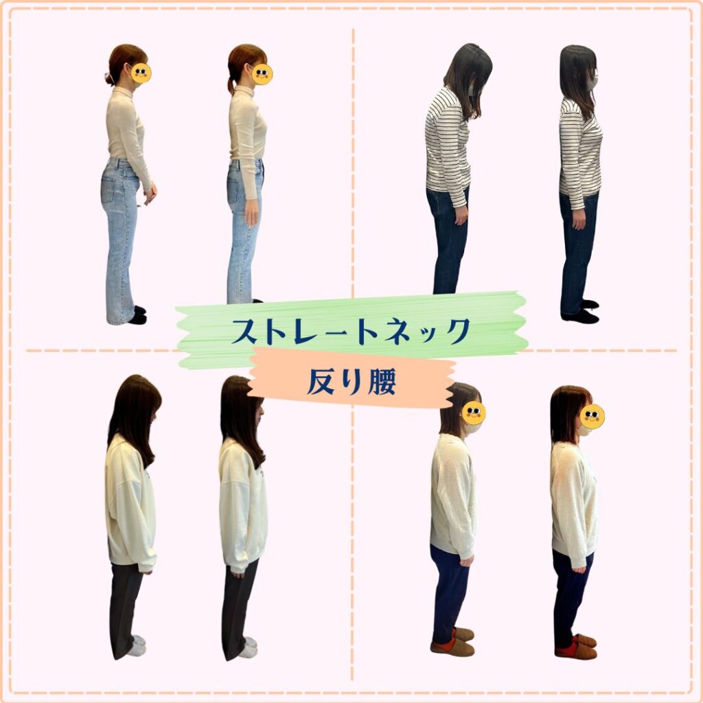 ストレートネックビフォーアフター