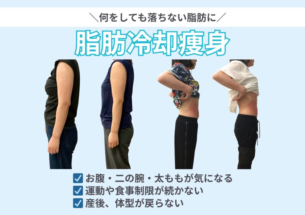 脂肪冷却瘦身ビフォーアフター