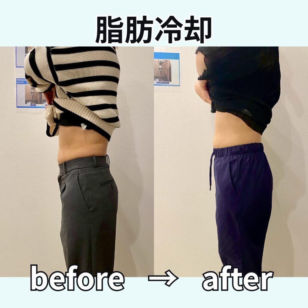 脂肪冷却瘦身≪お腹≫ビフォーアフター