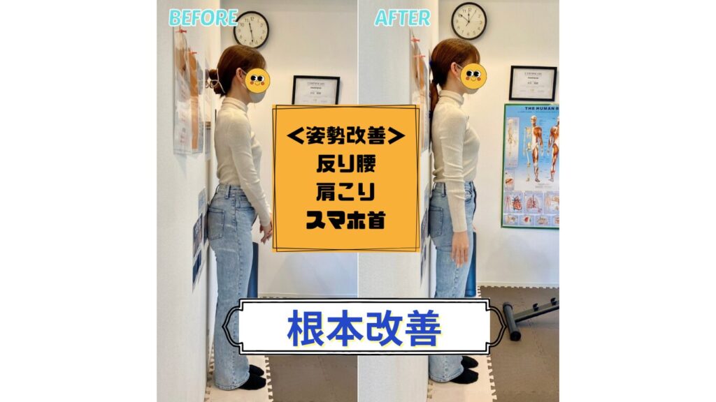 反り腰・肩こり・スマホ首
姿勢ビフォーアフター
