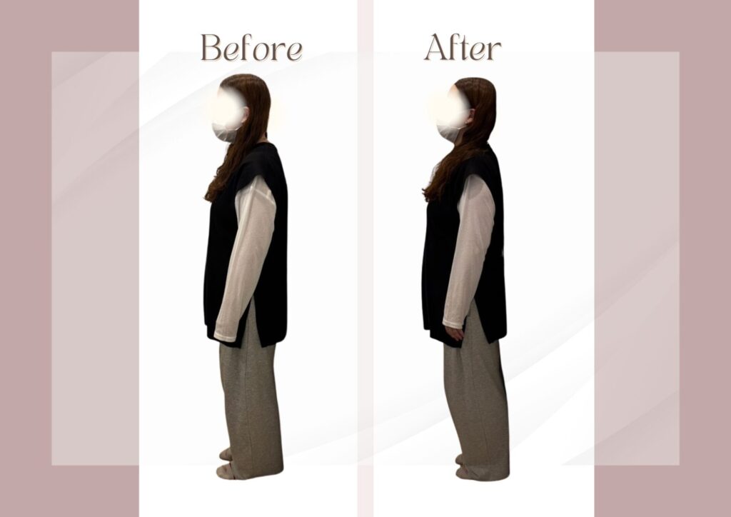 姿勢矯正ビフォーアフター