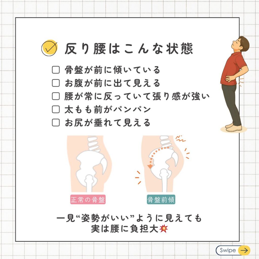 反り腰はこんな状態