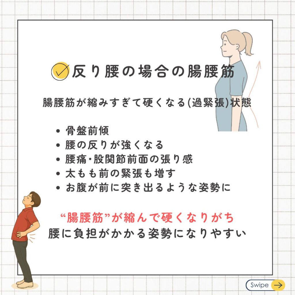 反り腰の人の腸腰筋