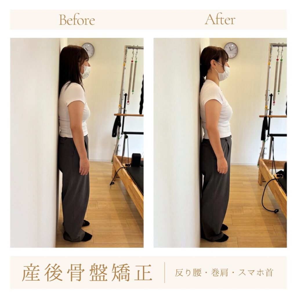 産後骨盤矯正ビフォーアフター