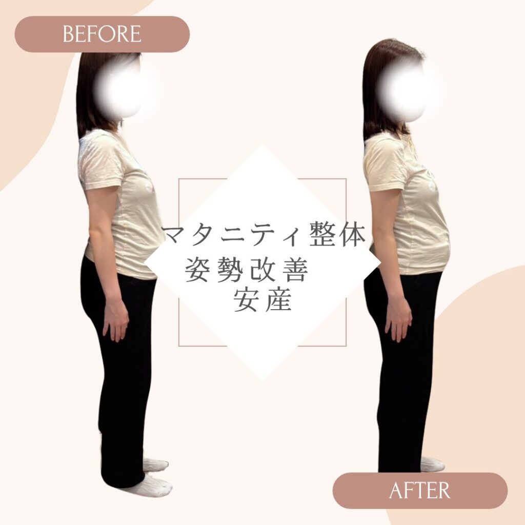 マタニティ整体ビフォーアフター