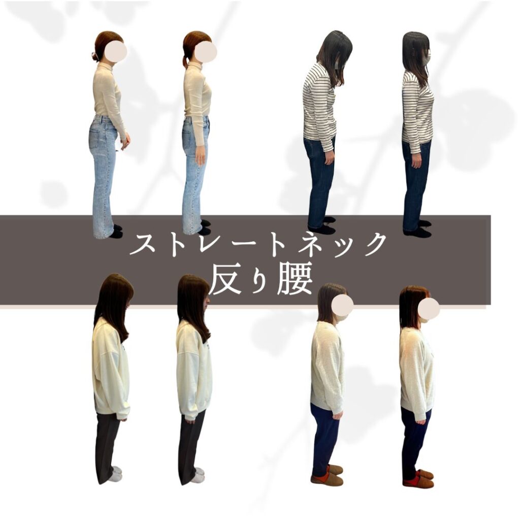 冬のギックリ腰