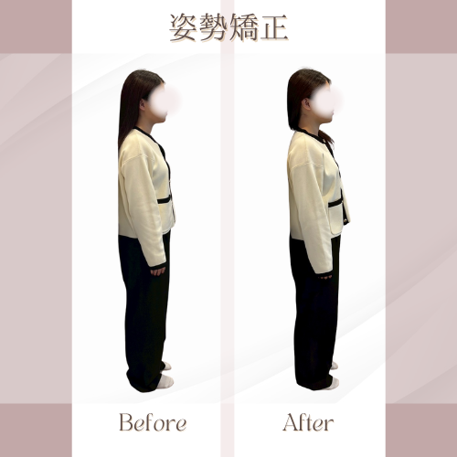 姿勢矯正ビフォーアフター